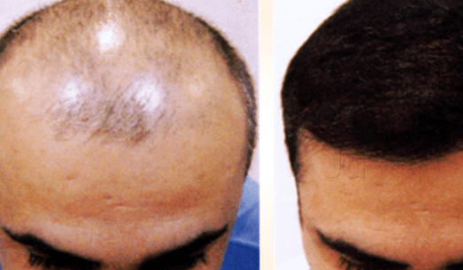 Roots Hair Transplant Laser Centre